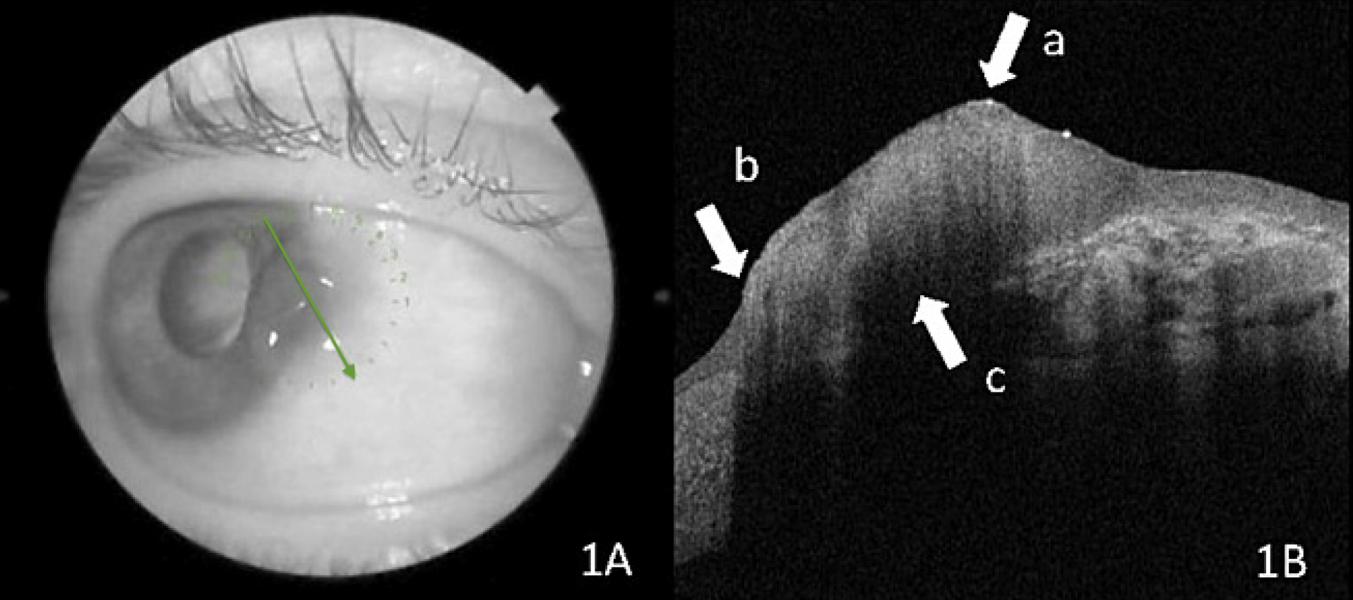 Oct Can Help Diagnose Ocular Surface Squamous Neoplasia